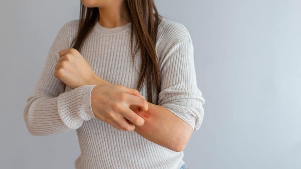 What are the symptoms of reverse psoriasis?